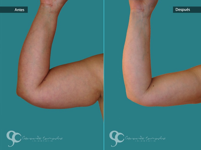 Testimonio braquioplastia Colombia